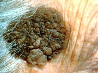 Seborroisk keratose Seborroisk keratose