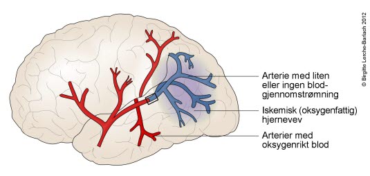 Hjerneinfarkt Hjerneinfarkt