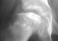 Calvé-Legg-Perthes sykdom 1 Calvé-Legg-Perthes sykdom 1