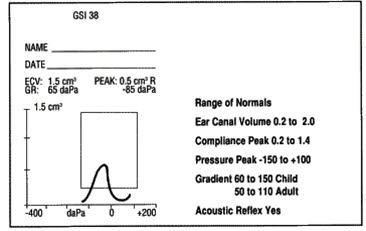 Tympanometri, normalverdier Tympanometri, normalverdier