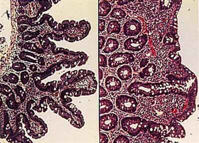 Normal slimhinne til venstre
