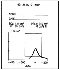 Tympanogram, normalt