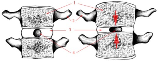 Skive med og uten kompresjon