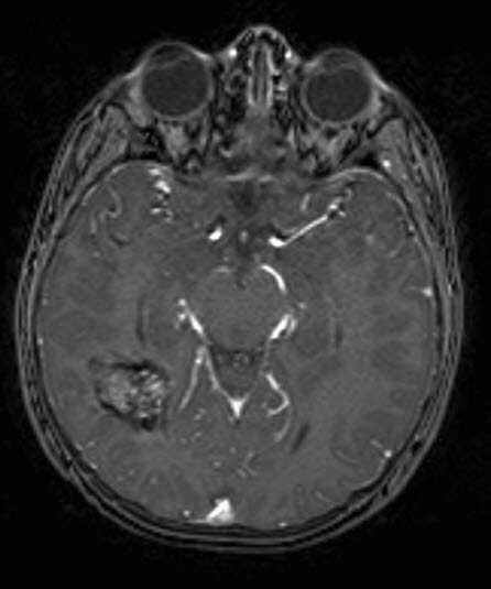 kavernøst hemangiom 1