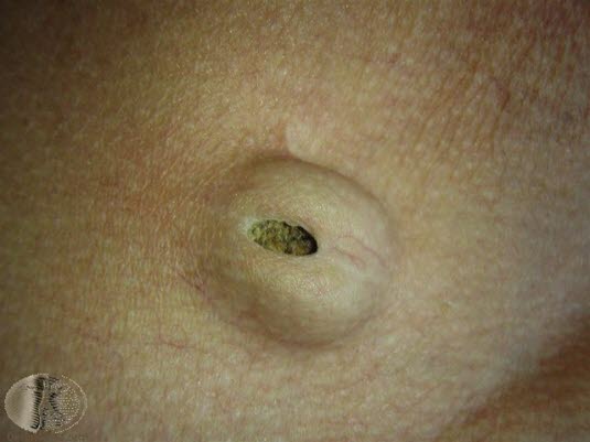 Epidermoid cyste med åpning