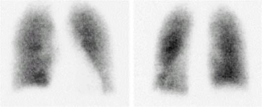 lungeemboli_Ventilasjonsscintigrafi