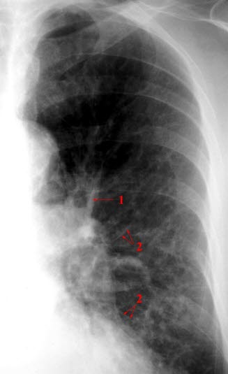 Hjertesvikt, lett-1 Hjertesvikt, lett-1