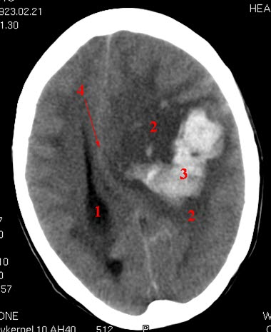 Cerebral blødning med overskyvning (CT) Cerebral blødning med overskyvning (CT)