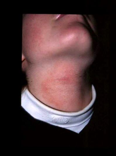 Umiddelbart etter kryobehandling av epidermal nevus.