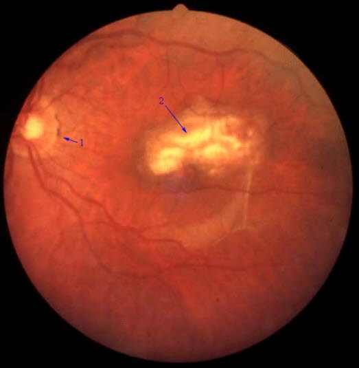 Senil makuladegenerasjon