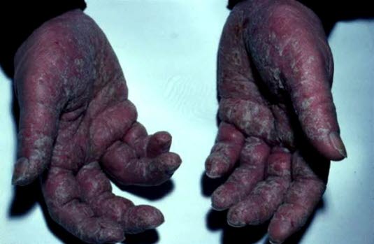 Kraftig fortykket og betent hud i håndflaten.