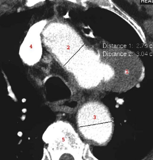 Aneurisme arcus aorta (CT) Aneurisme arcus aorta (CT)