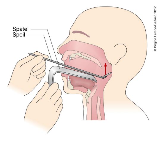 Speilundersøkelse av øvre del av svelget.