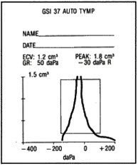Tympanogram, tynn, arrete trommehinne Tympanogram, tynn, arrete trommehinne