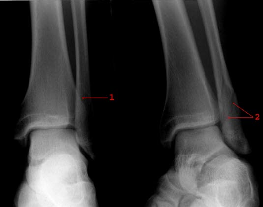 Malleolfraktur Malleolfraktur