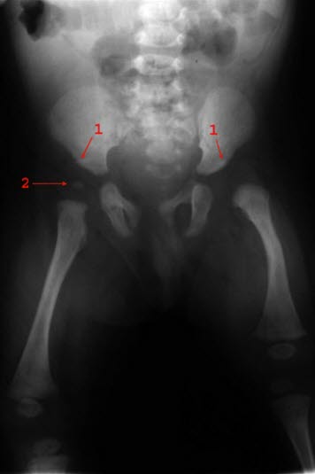 Hofteleddsdysplasi Hofteleddsdysplasi