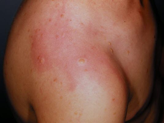 Kutan masteocytose - Darier's tegn. Kutan masteocytose - Darier's tegn.