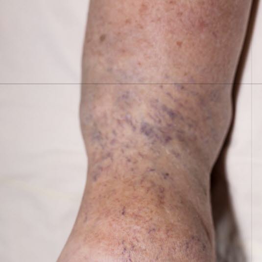 Ankelødem Ankelødem