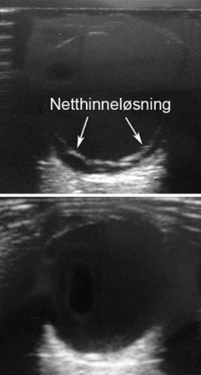 Ultralyd av netthinneløsning