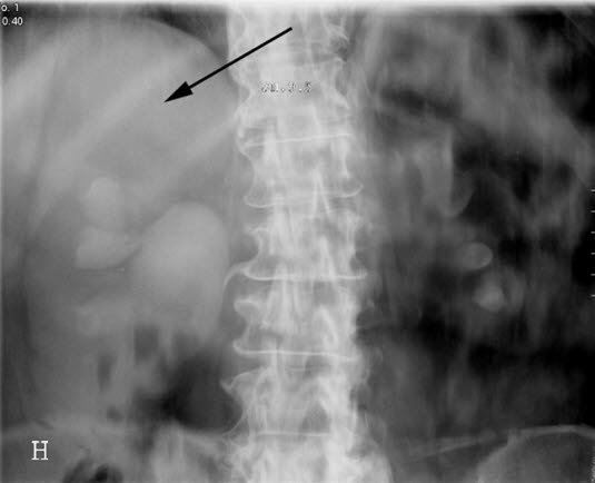 Nyrecyste (urografi) Nyrecyste (urografi)